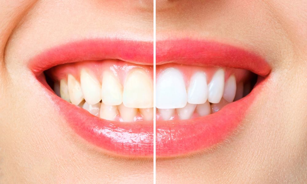 Cesta k bielym zubom a žiarivému úsmevu. Aké sú možnosti 