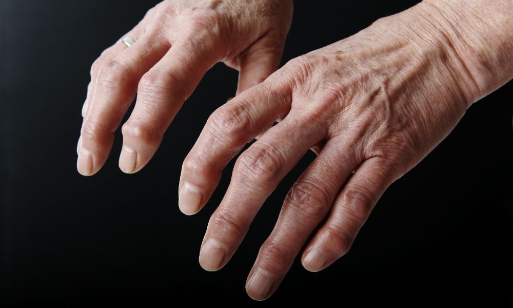 Trápi vás artróza? Všetko, čo o ochorení potrebujete vedieť