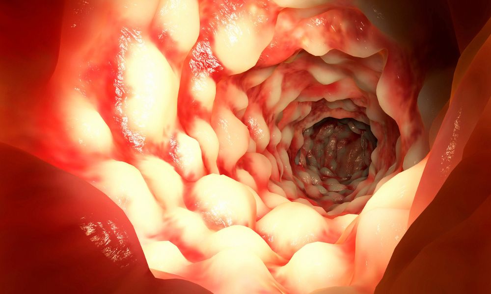 Crohnova choroba - čisté črevo