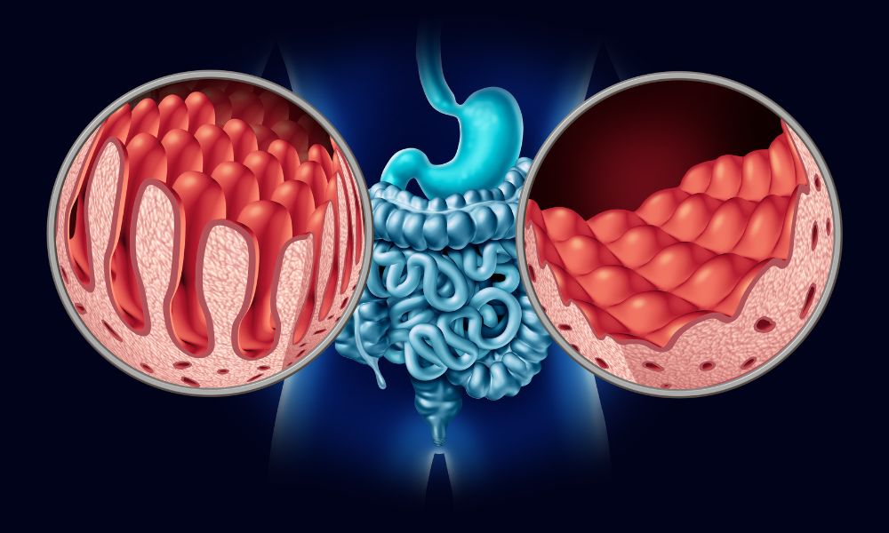 Crohnova choroba - zdravé črevá