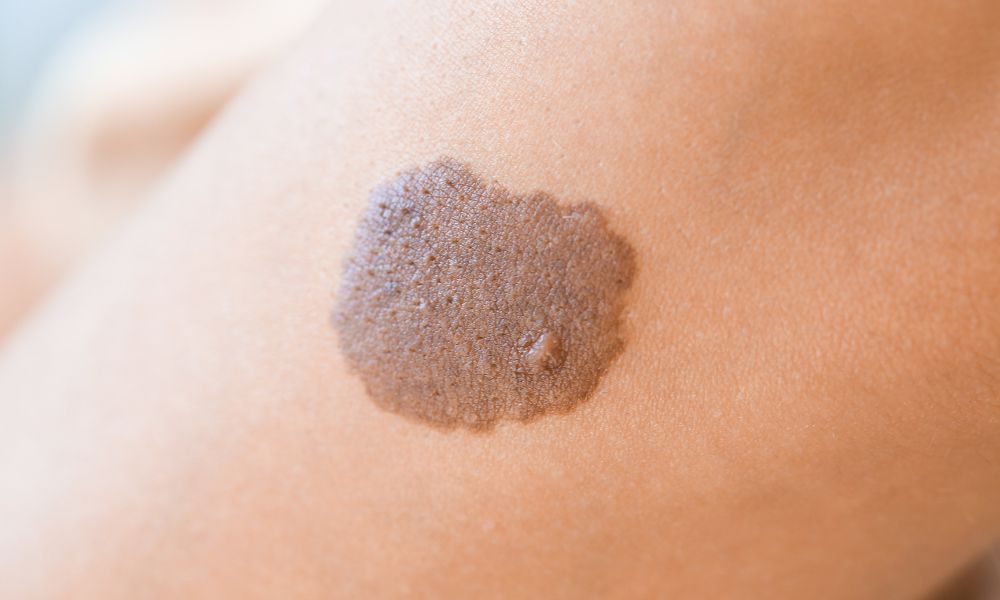 Nebezpečná rakovina kože. Ako sa chrániť? Materské znamienko.