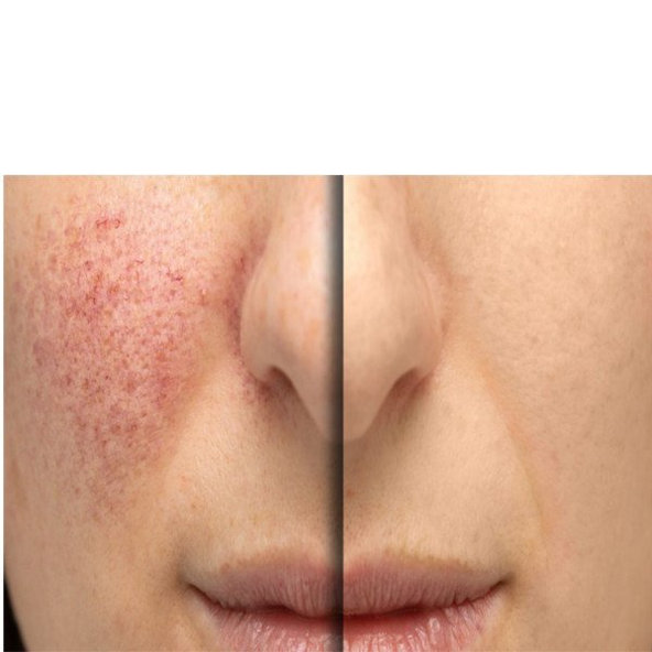 ENDOR LASERGEN regeneračný krém po ošetrení laserom 100ml