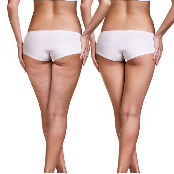 ENDOR Anti-Cellulite krém na redukciu celulitídy 200ml