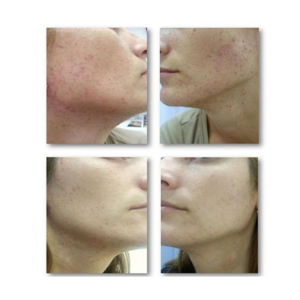 Zmatňujúce tonikum pre mastnú a problematickú pleť Acnaut Biotrade 60ml