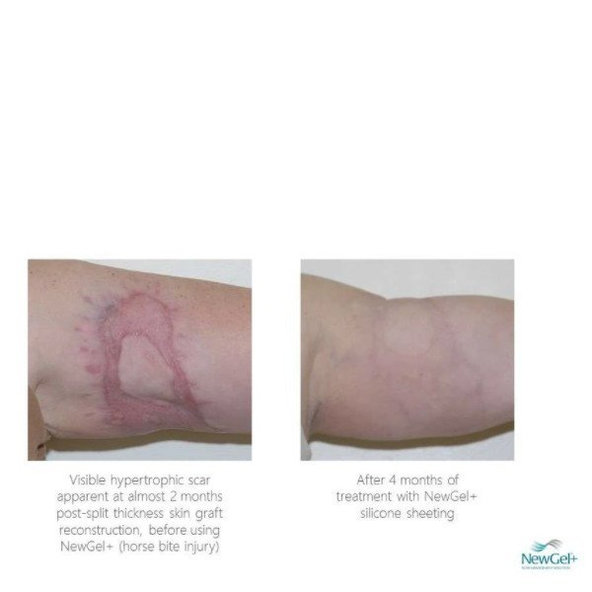 NewGel+ Priehľadná silikónová náplasť (1 ks) NG-301