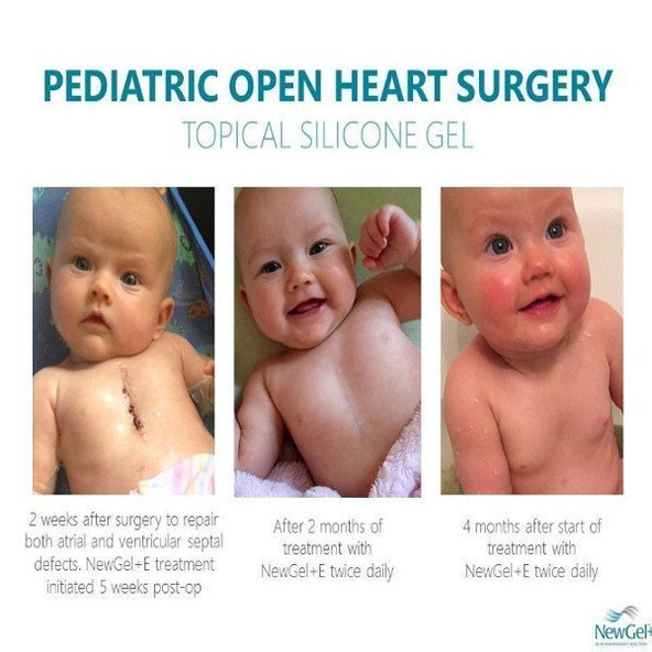 NewGel+ Priehľadná silikónová náplasť (1 ks) NG-301