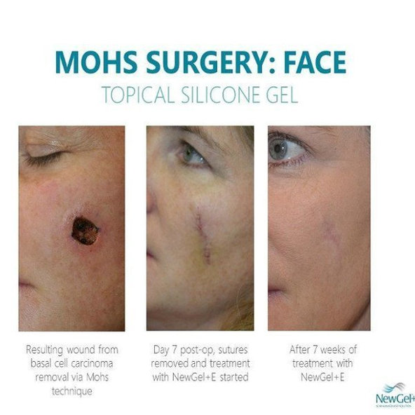 NewGel+ Priehľadná bodová náplasť (6 ks) NG-380