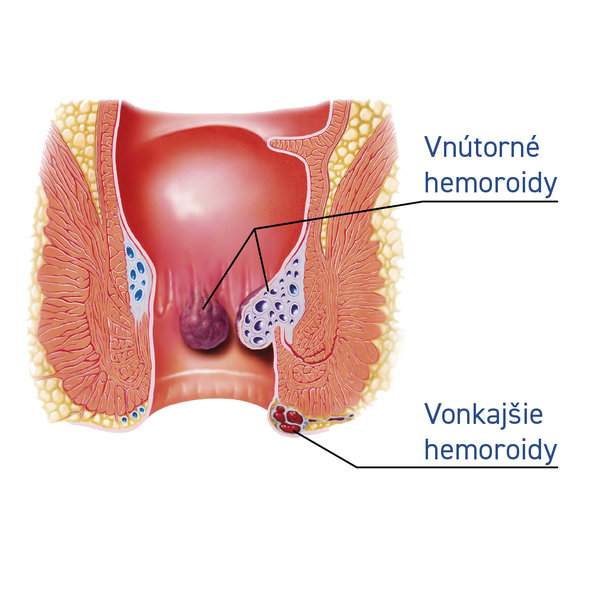 Diozen Forte na kŕčové žily a hemoroidy 1000mg/30tbl