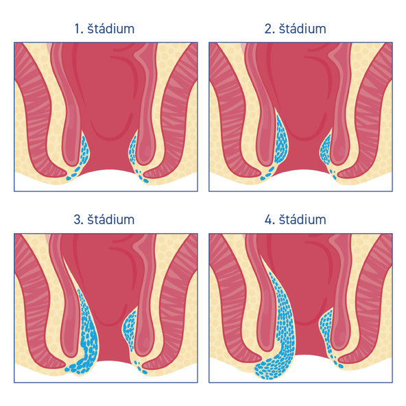 Diozen Forte na kŕčové žily a hemoroidy 1000mg/30tbl
