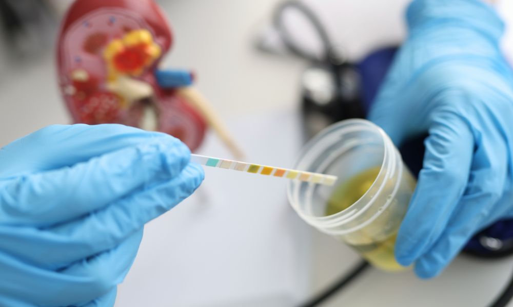  Test na zápal močových ciest v ordinácii, vyhodnotenie moču pomocou testovacích prúžkov na zisťovanie prítomnosti infekcie alebo zápalu močovej rúry