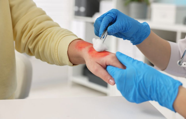 Ošetrenie popáleniny od oleja v ambulancii – dezinfekcia rany