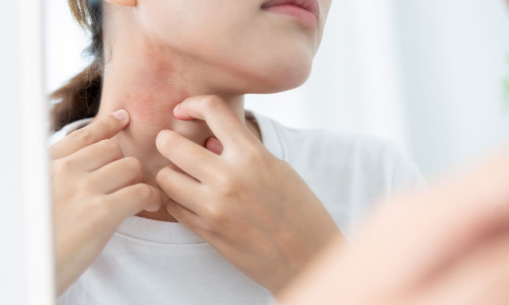  Žena v bielom tričku si škrabe začervenané a podráždené miesto na krku pred zrkadlom, čo znázorňuje reakciu citlivej pleti na jarné alergény.