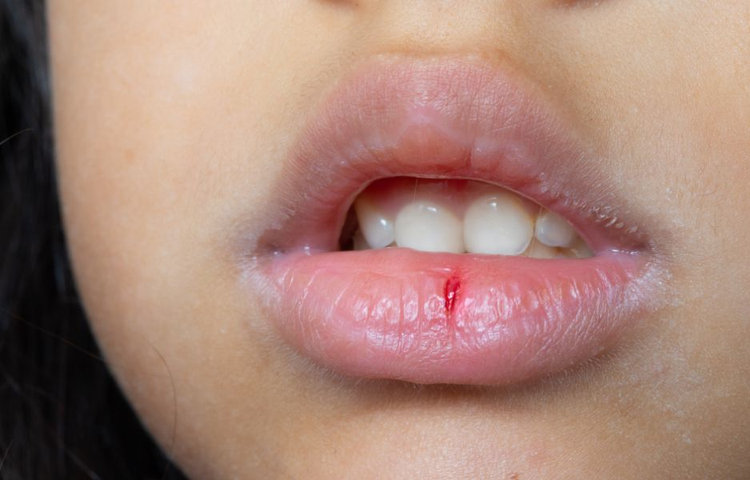 Detail popraskaných pier s drobnou rankou znázorňuje suché pery vo februári, poškodenú kožnú bariéru a potrebu intenzívnej starostlivosti o pery v zime.