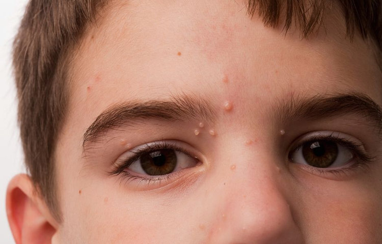 Molusky u detí okolo očí – ako vyzerajú molusky na tvári