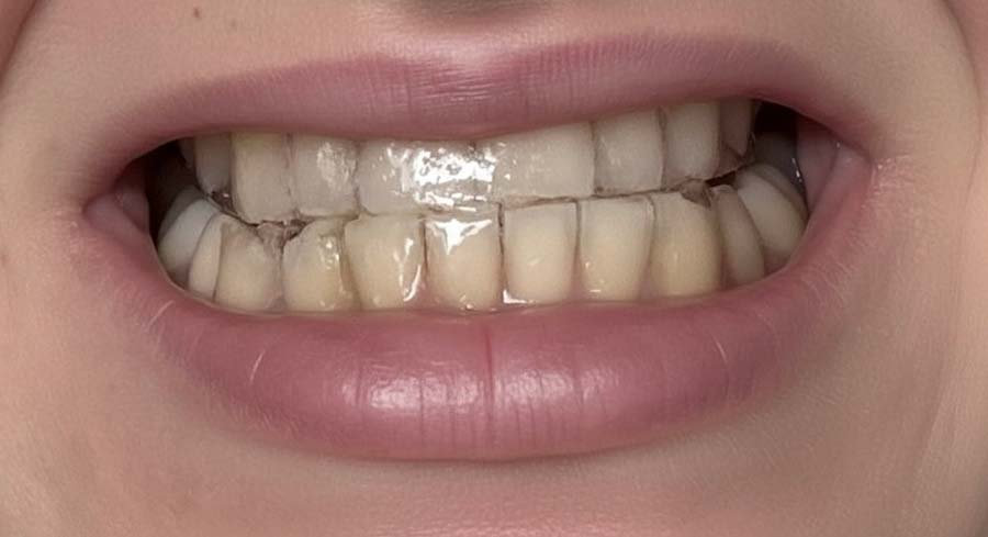  Aplikované bieliace pásiky Hello coco na zuboch počas domáceho bielenia, viditeľný rozdiel v odtieňoch zubov a účinné odstránenie zafarbenia spôsobeného jedlom a nápojmi.