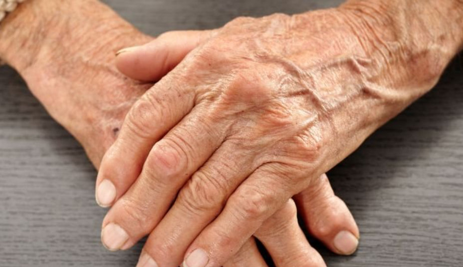 Artritída – príznaky, rizikové faktory a liečba