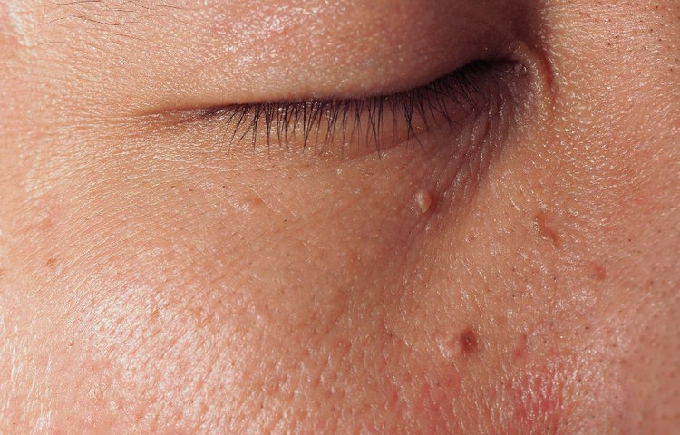 Infekcia hpv vírusom – bradavice v oblasti očí spôsobené vírusom hpv