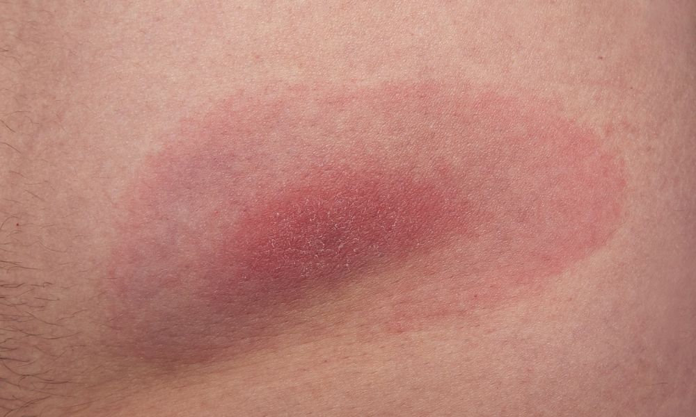  Detail kože s výrazným červeným zarudnutím a opuchom v okolí štípanca od kliešťa, ktorý môže signalizovať zápal alebo infekciu po uhryznutí.