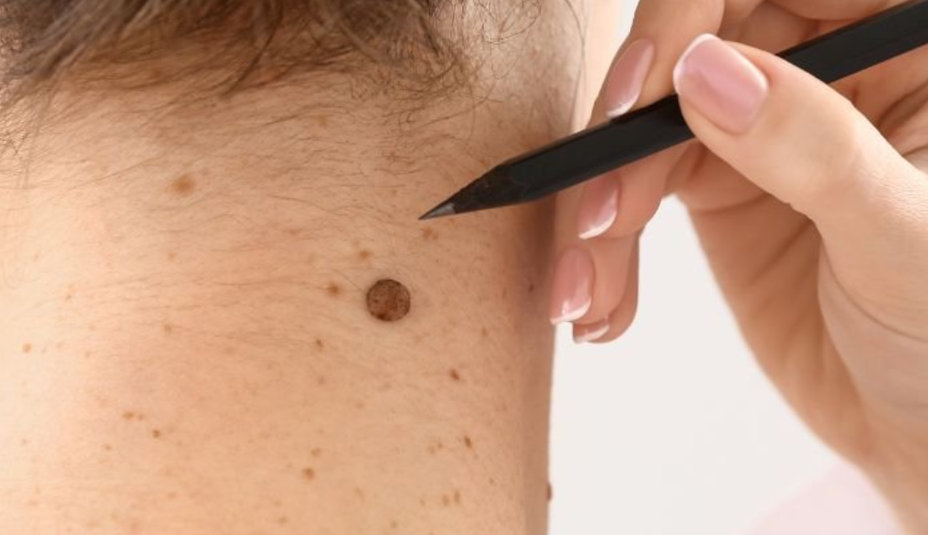Nebezpečná rakovina kože. Ako sa chrániť?